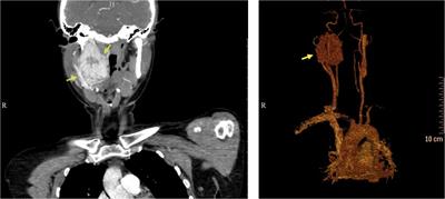 Genetic changes in the FH gene cause vagal paraganglioma